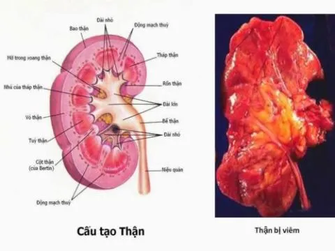 Điều trị viêm thận